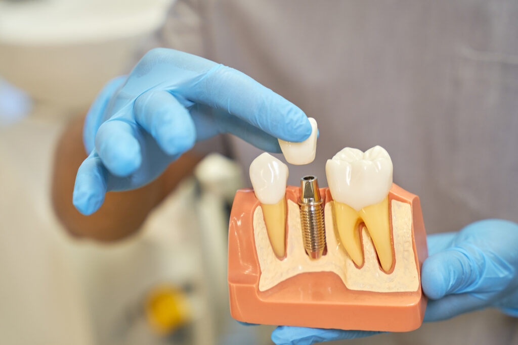 implantes dentales indoloros alicante